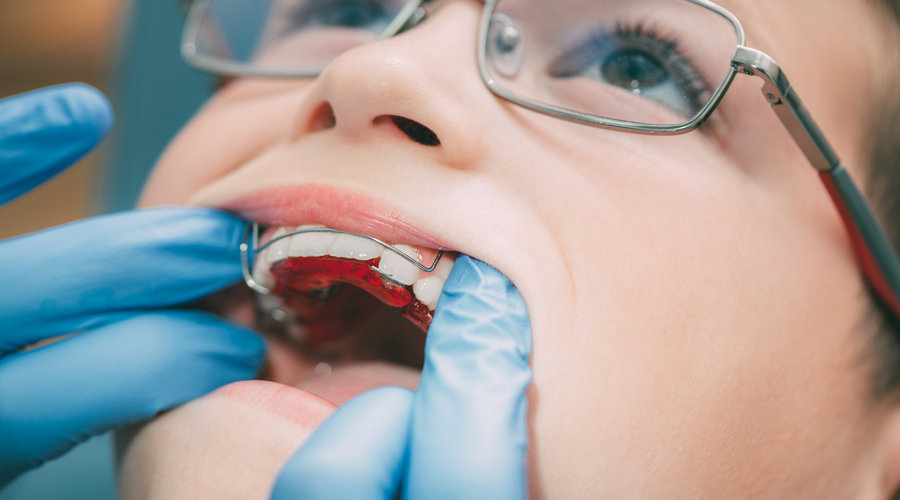 Gaziantep Ortodonti Nasıl Yapılır? - Gaziantep Ortodonti, Gaziantep Ortodontist