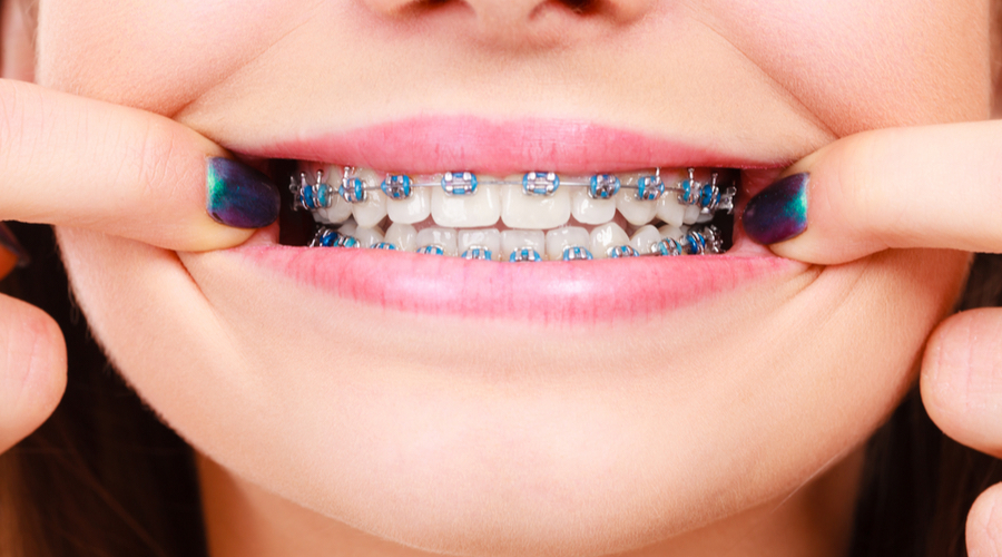 Gaziantep Ortodonti Nedir? - Gaziantep Ortodonti, Gaziantep Ortodontist